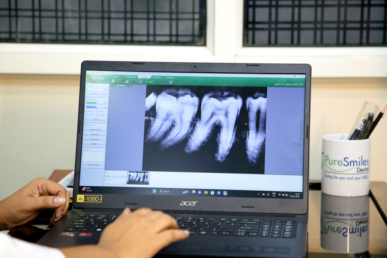 https://puresmilesdental.in/wp-content/uploads/2023/12/image6-1280x853.jpg
