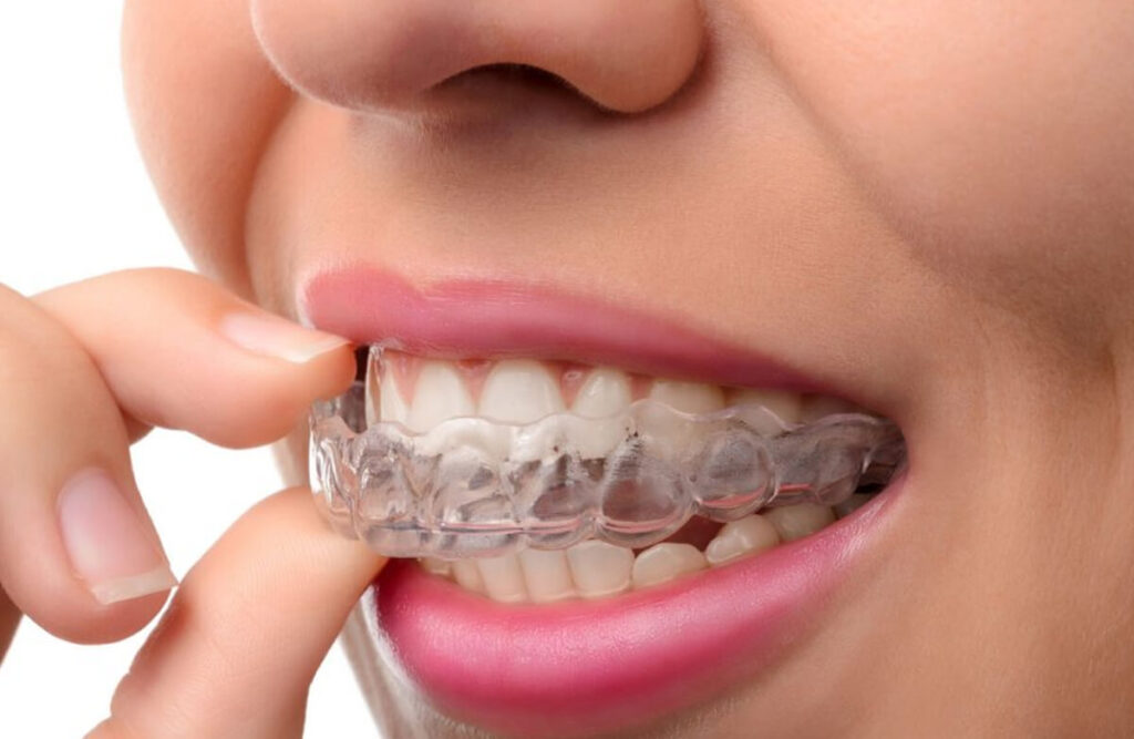 https://puresmilesdental.in/wp-content/uploads/2024/02/alignment-1024x667-1.jpg