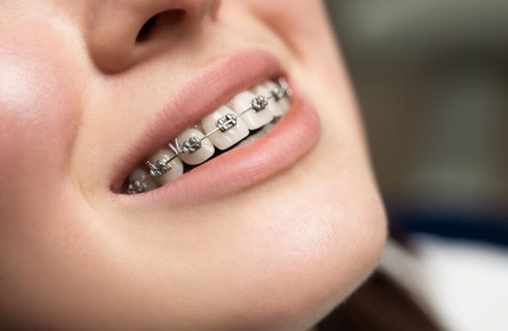 https://puresmilesdental.in/wp-content/uploads/2024/02/brace-1024x667-1.jpg