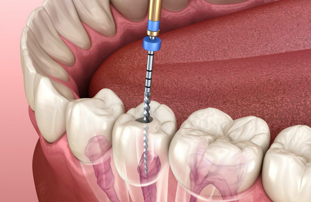 https://puresmilesdental.in/wp-content/uploads/2024/02/root-1024x667-1.jpg
