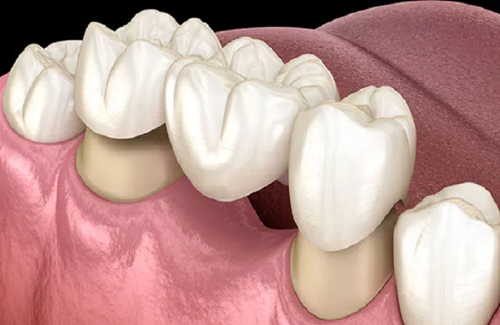 https://puresmilesdental.in/wp-content/uploads/2024/03/shutterstock.jpg