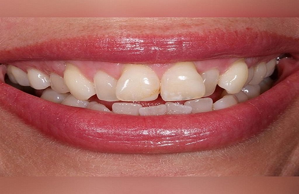 teeth-2